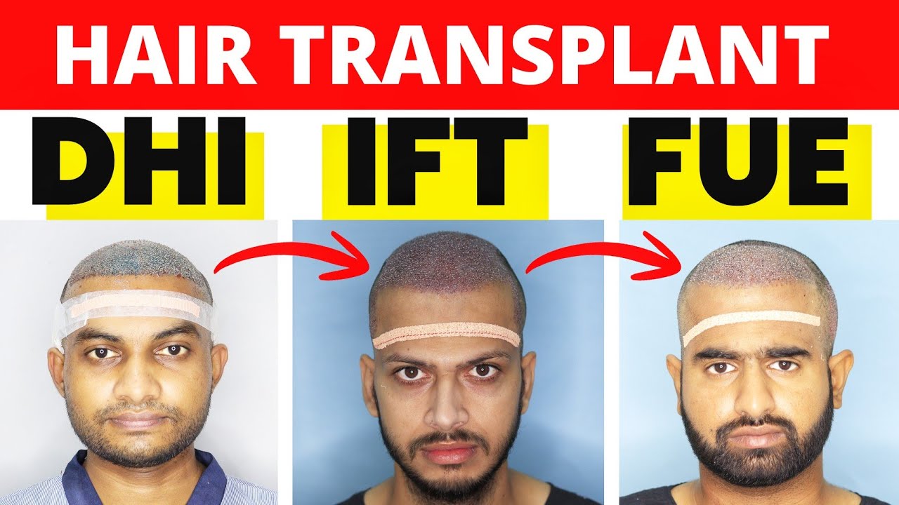 Best Hair Transplant Technique Of 2026 🔥🔥🔥 