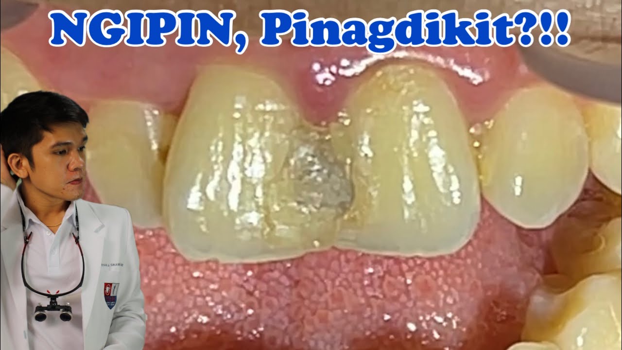 Pinagdikit na PASTA NG NGIPIN Retreatment of Old Tooth Filling 🦷 YouTube