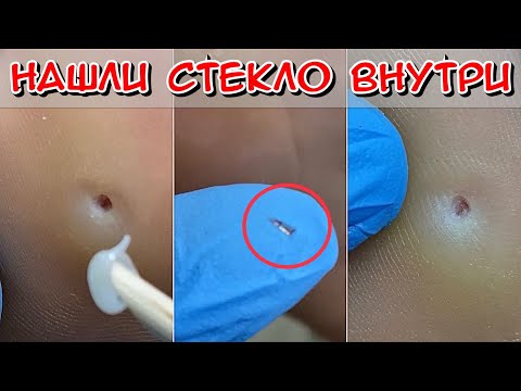 Нашли стекло внутри / Осколок стекла в ноге / Стержневая мозоль / на подошве стопы мозоль что делать