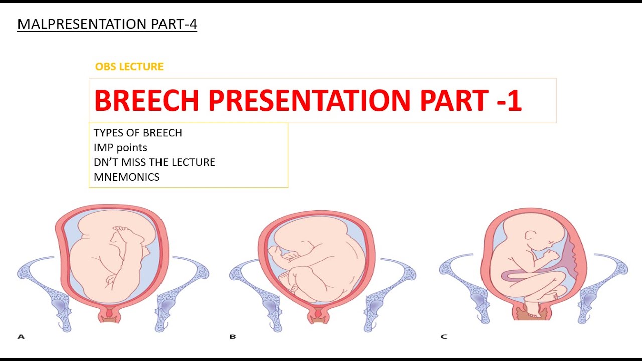 breech presentation clinical features
