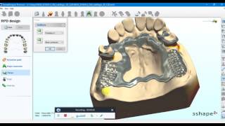 Digital RPD Design in 3Shape Dental System 2010