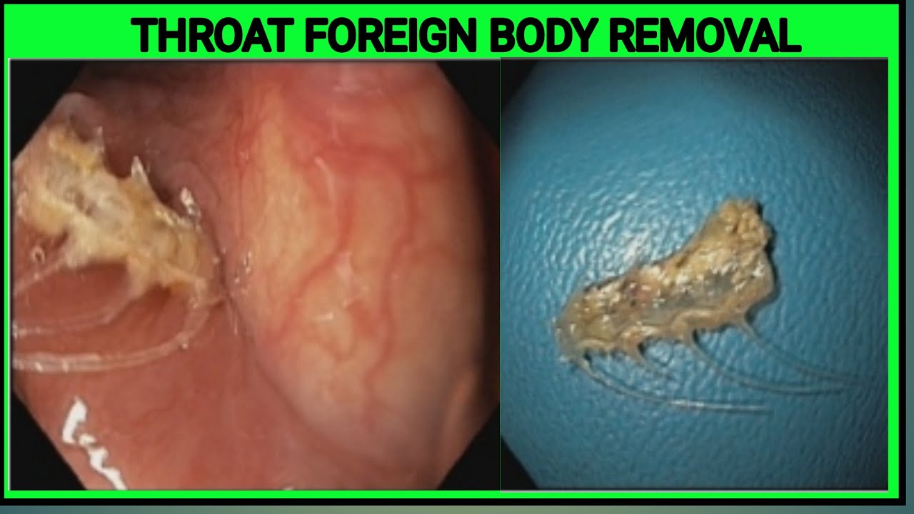 Fish Bone in the Throat II Endoscopic Foreign Body Removal BD_ENDOSCOPY YouTube