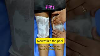 Chemical peel for dark knees by Dr.Neetisha Agarwal #dermatologist #gandhinagar #darkknees #peeling