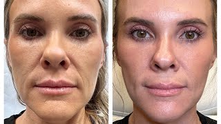 Nefertiti Lift Explained