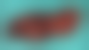 Spleen preserving distal pancreatectomy without splenic vessel preservation - Warshaw technique.