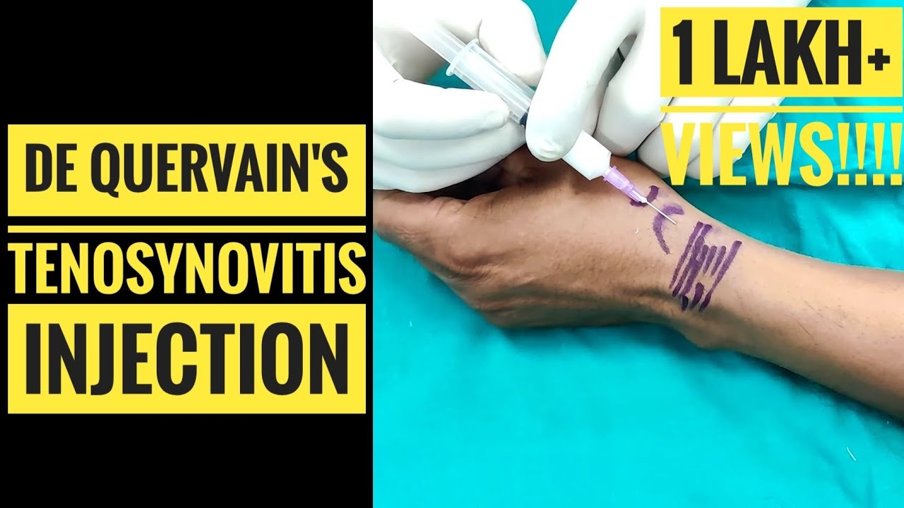 Injection Technique For De Quervains Tenosynovitis Epomedicine | The ...