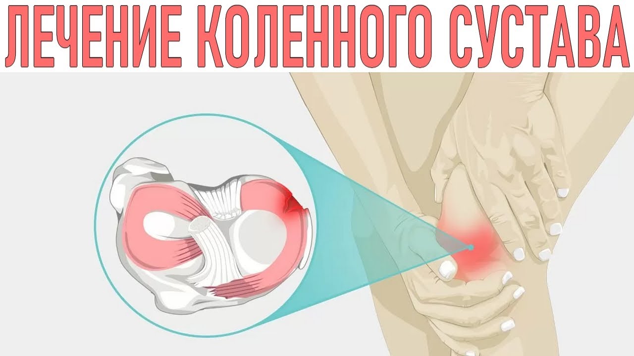 разрыв мениска коленного сустава 2 степени