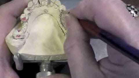 R P D Design - Ken Class III Mand Cast 2 3 3 Part D