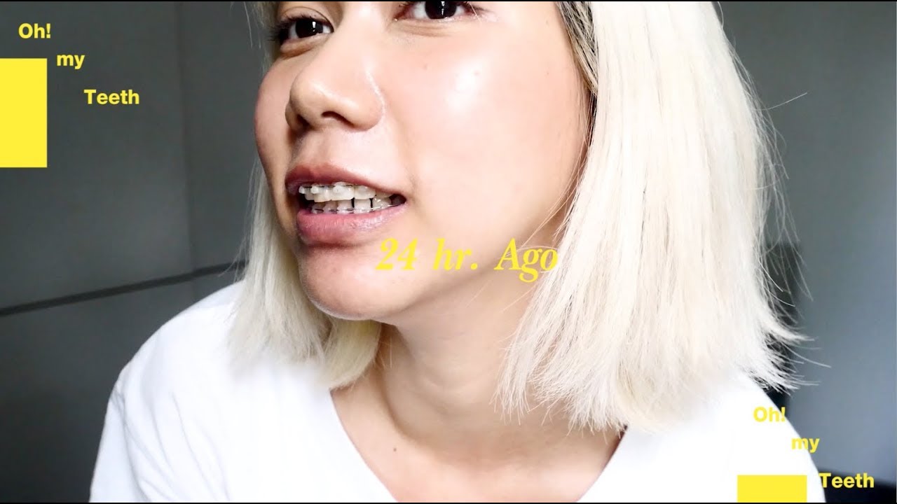 24 ชม.แรก!! ใส่เหล็กล่าง เข้าใจแล้วว่าทรมานกว่า 😭 . Ploy Sapphires