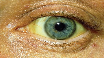 12 Effective Home Remedies for Jaundice THAT WORK!