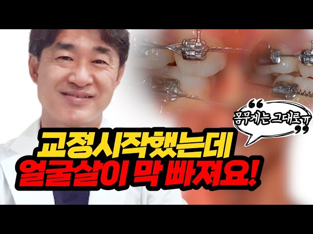 교정시작했는데 얼굴살이 막 빠져요!! (몸무게는 그대로ㅠ)