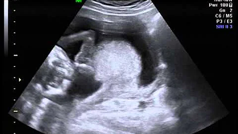 Ultrasound Julie Irvin