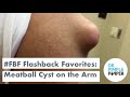 Flashback Favorites: Meatball Cyst on the Shoulder!