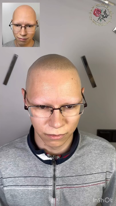 Тотальная алопеция скрыта тату волос, трихопигментация. Scalp ...