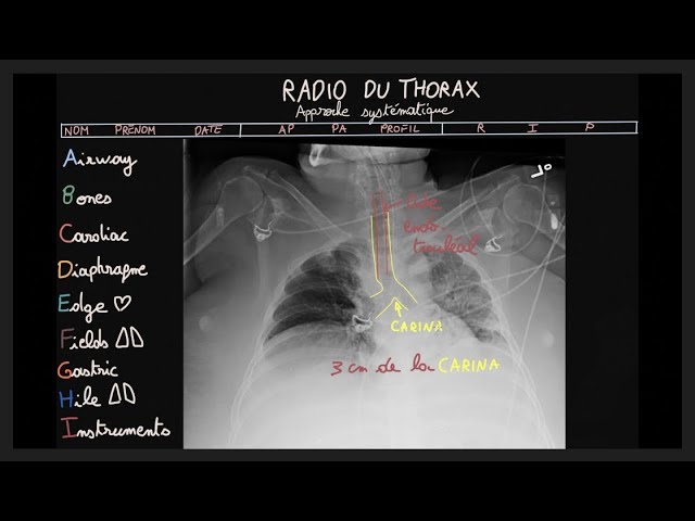 Radio Du Thorax Abcdefghi Partie 2 Docteur Synapse Youtube Radio Du Thorax Abcdefghi Partie 2 Docteur Synapse Youtube