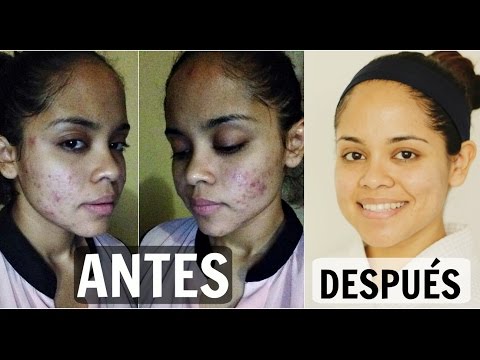 COMO CURÉ MI ACNÉ QUISTICO Y HORMONAL (ACNE SEVERO)!!Í