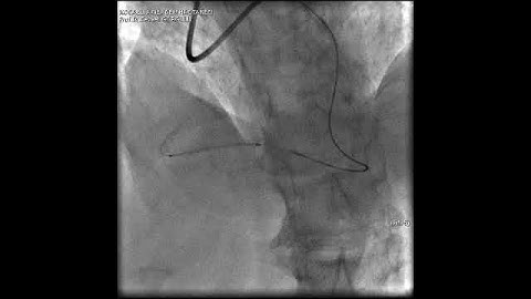Aortic dissection and radial rupture during retrograde CTO PCI: Management of complications VİDEO 24