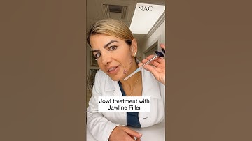 Jowl Treatment with Jawline Filler #drbitafarrell  #fillers #beauty