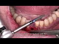 Dr stefan p hicklin  straumann blt  29 mm implant