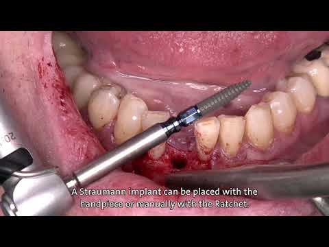 Dr. Stefan P. Hicklin:  Straumann® BLT Ø 2.9 mm implant