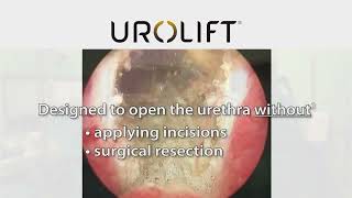 UroLift™ System Treatment
