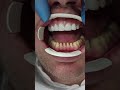 Before and after zirconium crowns