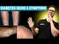 28 Diabetes Signs &amp; Symptoms [REVERSE DIABETES + 2 BIG SECRETS!]