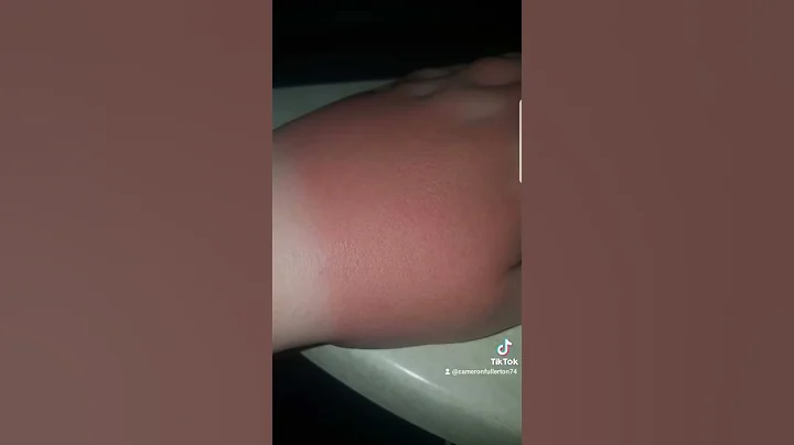 burned hand
