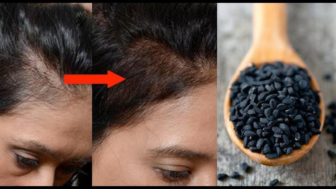 गंजापन, बाल गिरना और सफेद बालों का अचूक इलाज है कलौंजी ...