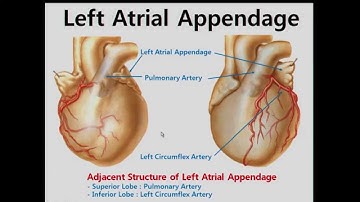 Cardiac Anatomy and Electric Mapping for Ablation of Atrial Fibrillation