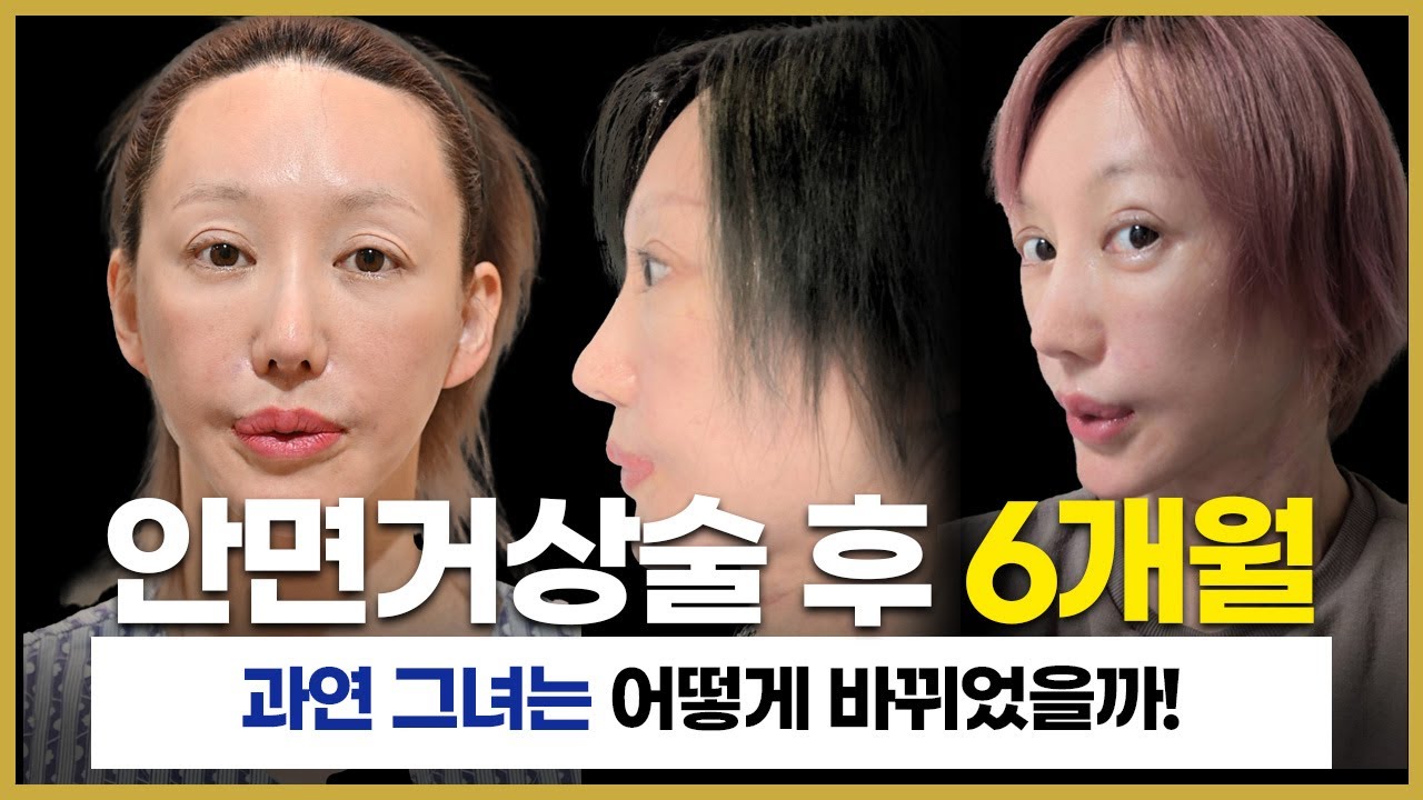 흉살이 많았던 안면거상 재수술 환자 6개월 , 어떻게 변했을까?