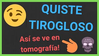 QUISTE TIROGLOSO ✳(tomografía)