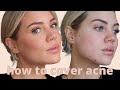 How to cover acne, redness & scarring | Elanna Pecherle 2021