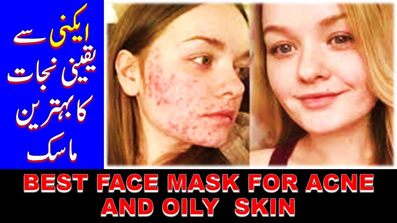 ایکنی سے یقینی نجات کا بہترین ماسک, Best Face Mask For Oily Acne Prone
