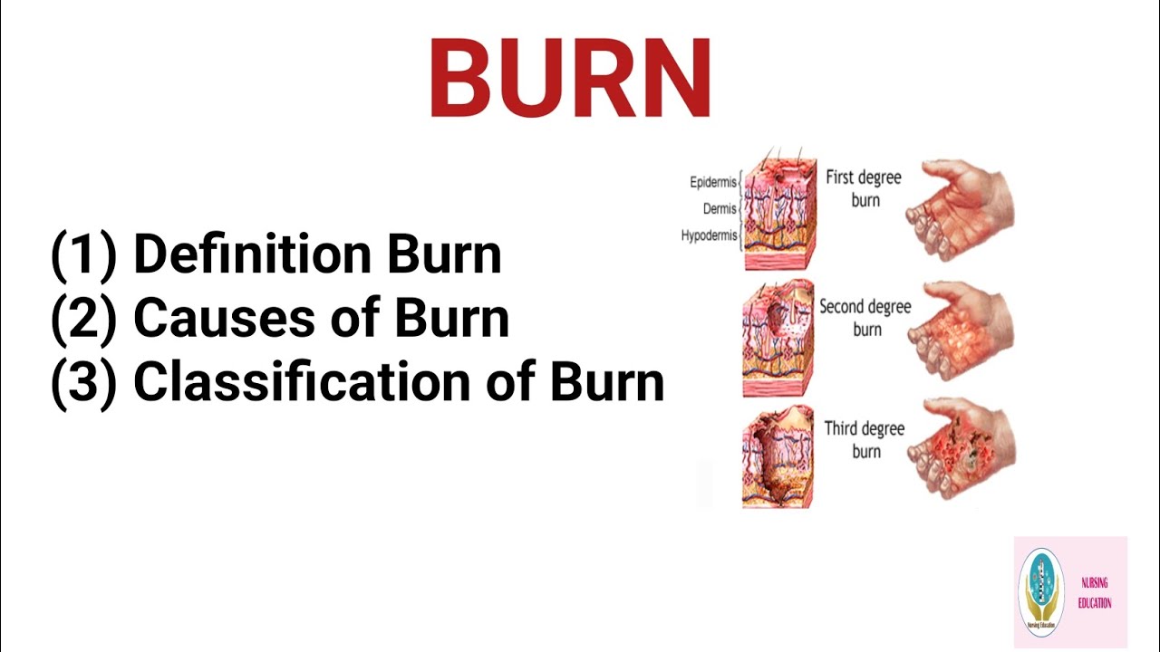 Topic- Classification of Burn|| Subject- Medical Surgical Nursing-||BSc nursing 3rd year 