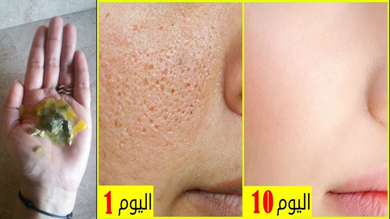 إدهني بها وجهك ستزول المسامات الواسعة و البثور وسيصبح وجهك أملس كطفلة