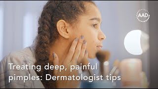 Treating deep, painful pimples: Dermatologist tips