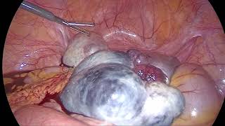 Post Ovulation Induction Ovarian Torsion - د لؤي أبوعتيله و علاج التواء المبيض بالمنظار