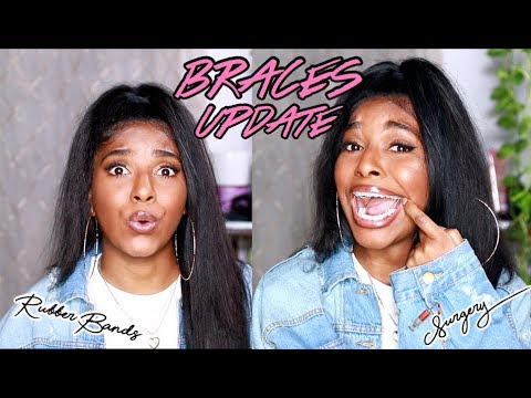 8&9-month-braces-update-|-jaw-surgery,-getting-rubber-bands!?