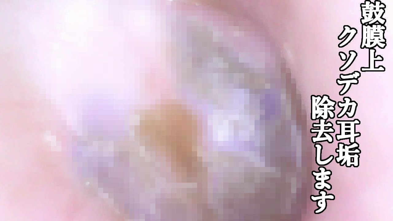 耳かき動画 鼓膜全体にはりついたクソデカ耳垢を除去します Youtube 耳かき動画 鼓膜全体にはりついたクソデカ耳垢を除去します Youtube