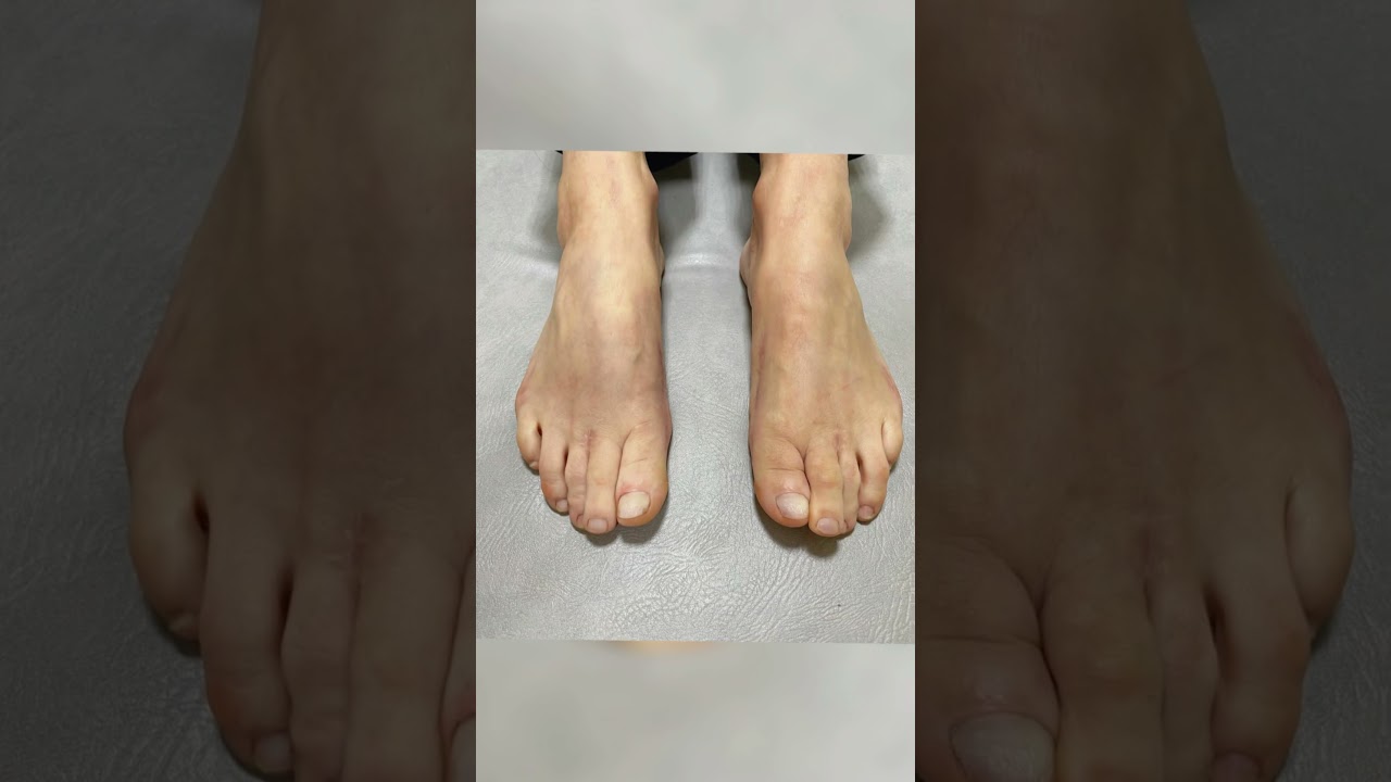 Результат после оперативного лечения Hallux Valgus спустя 1,7 лет🙏🏼 