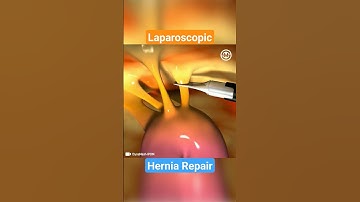 How Laparoscopic Mesh Repair Works for Hernia: A Step-by-Step Explanation #medical #meded  #hernia