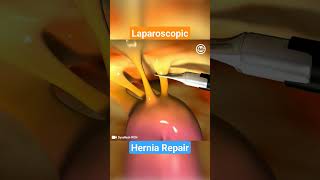 How Laparoscopic Mesh Repair Works For Hernia A Step-By-Step Explanation 