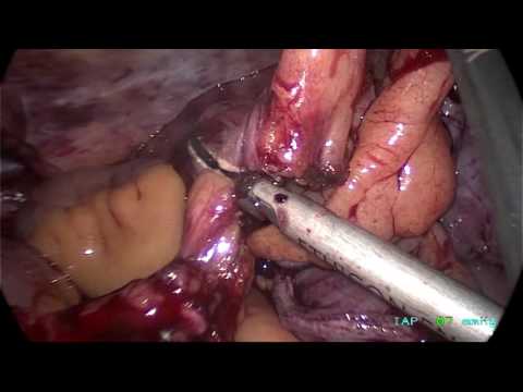 Colonic And Rectal Dissection For Laparoscopic Panproctocolectomy