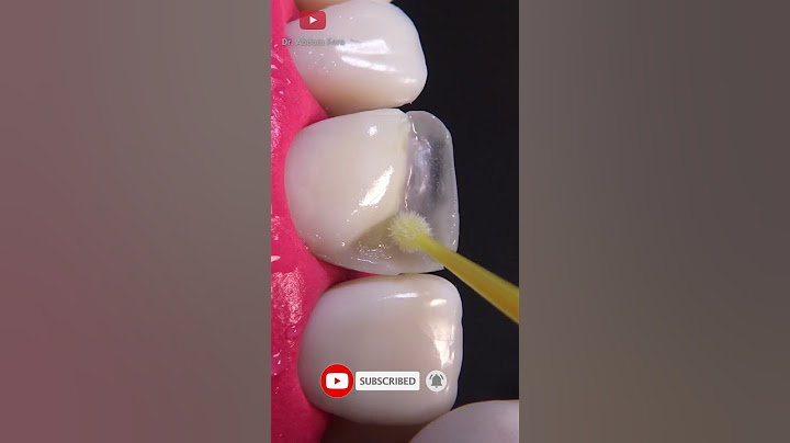 Awesome broken tooth restoration