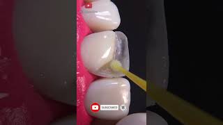 Awesome broken tooth restoration