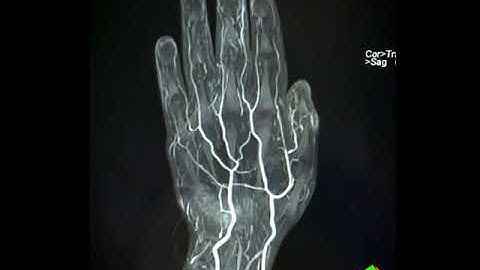 Contrast Enhanced MR Angiography of hand #radiology #cardiologist #mritech