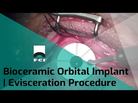 Vignette Bioceramic Orbital Implant | Evisceration | Procedure