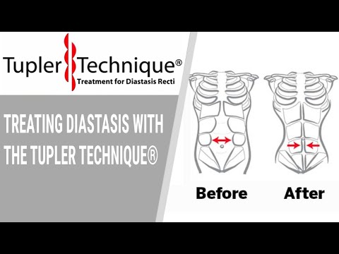 Video: Tehnica Tupler: Diastasis Recti Tratament După Sarcină