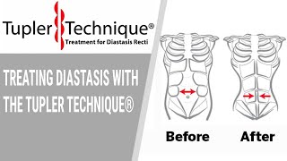 Treating Diastasis with the Tupler Technique® Julie Tupler, RN